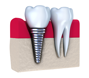 Dental Implants Glenview, IL & Wilmette, IL