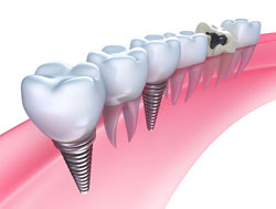 gum line with teeth and dental implants, Glenview, IL & Wilmette, IL